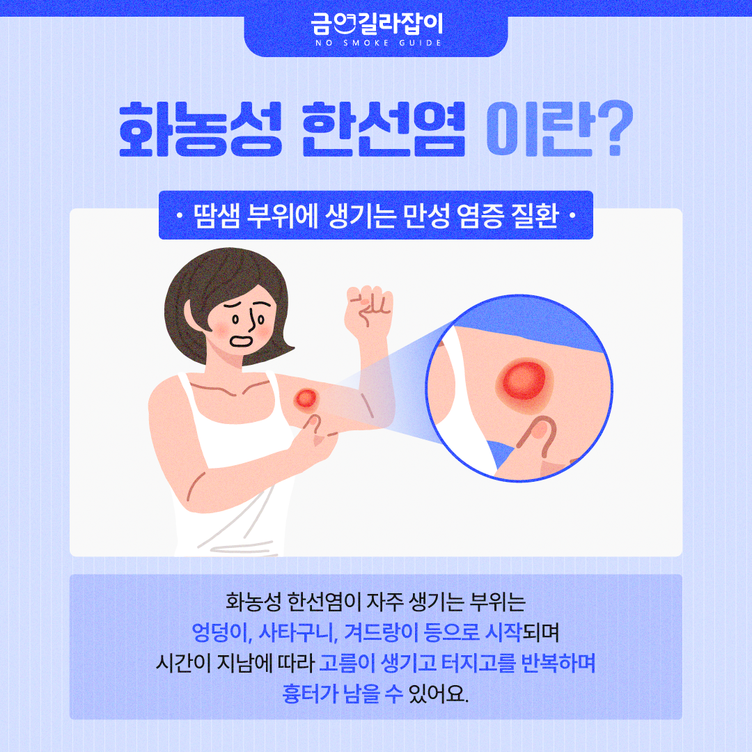 [카드뉴스] 화농성 한선염, 자꾸 생기는 종기 원인 흡연에도 있다 2